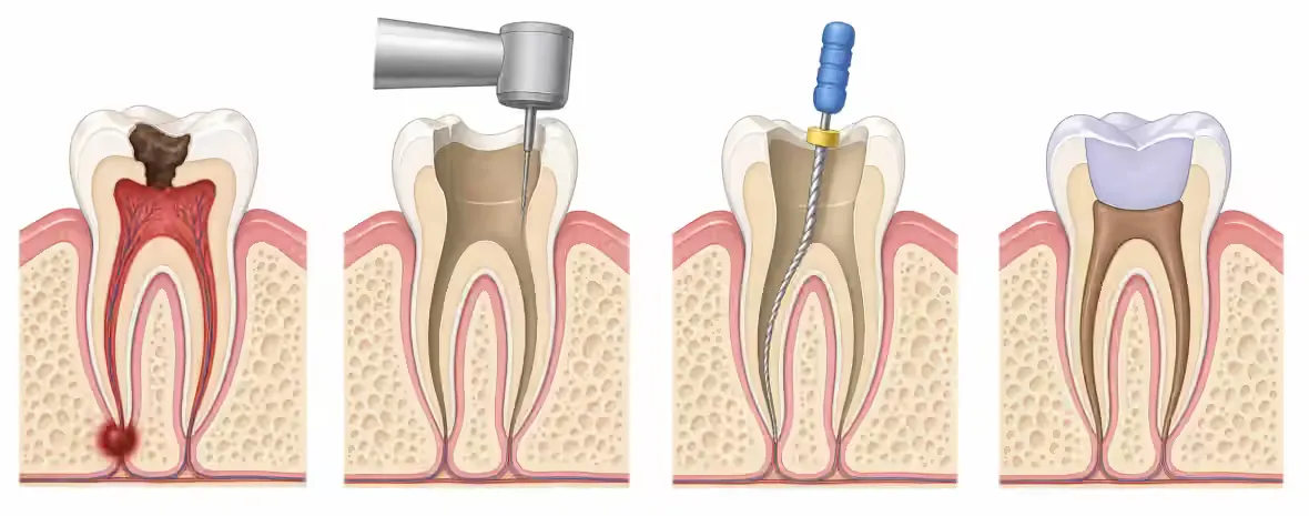 immagine rappresentativa dell'endodonzia