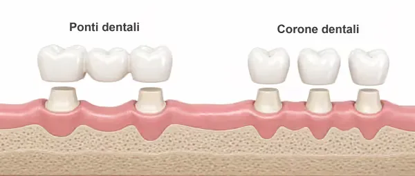 Immagine 3D di corone dentali e ponti dentali