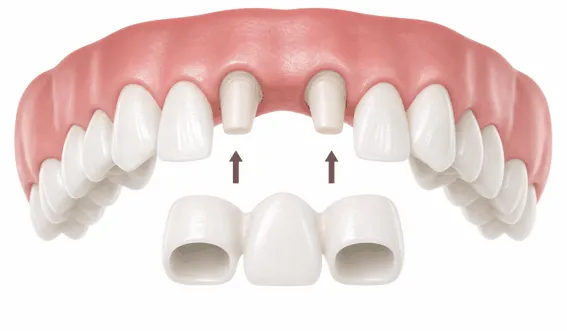 disegno che mostra l'applicazione di un ponte dentale
