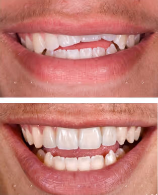 Immagine denti rovinati, e denti ripristinati dal dentista