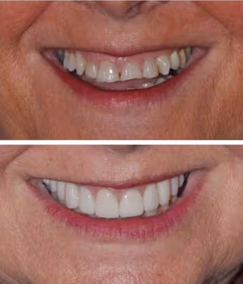 Immagine denti rovinati, e denti ripristinati dal dentista